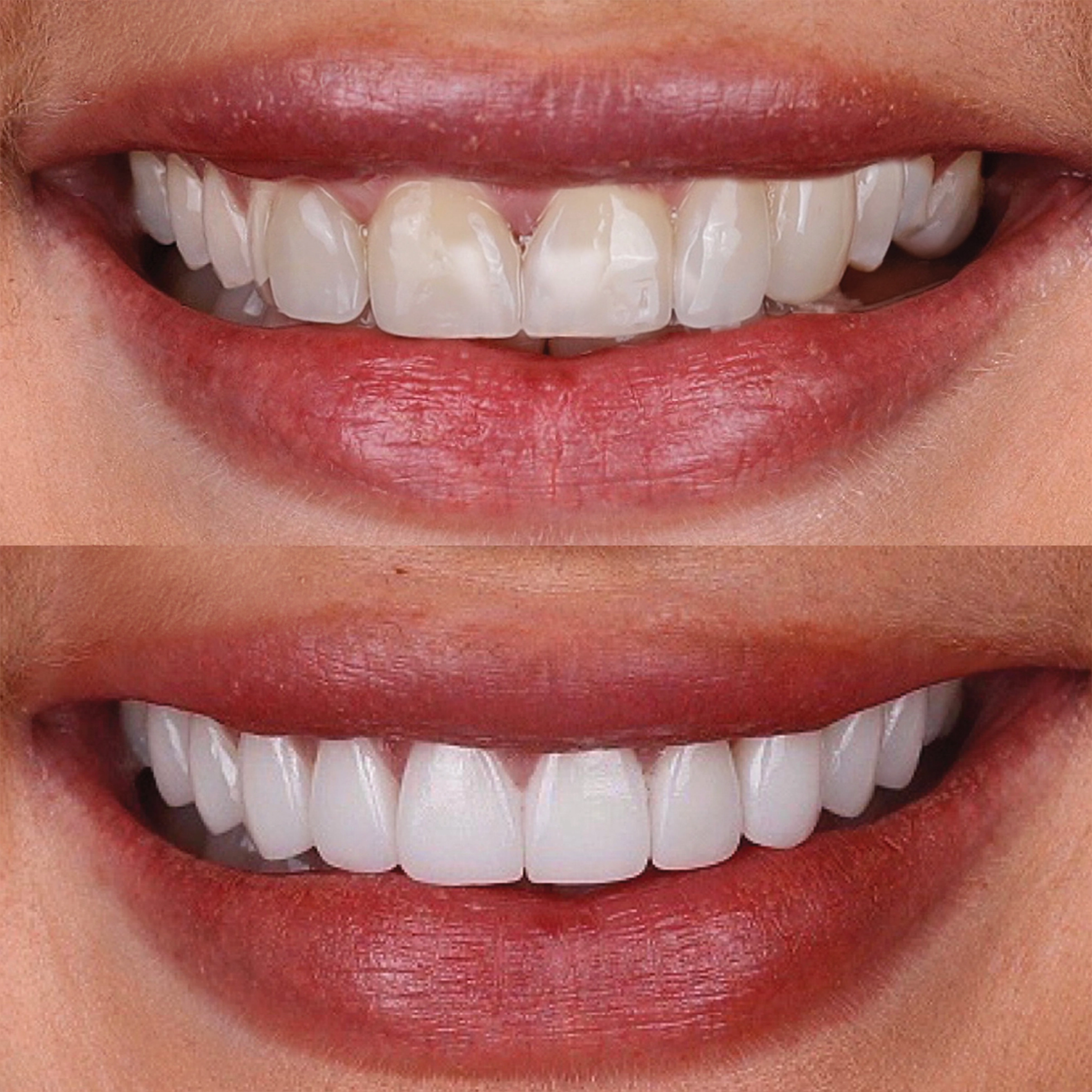 İmplant Tedavisi,All On Four Implant